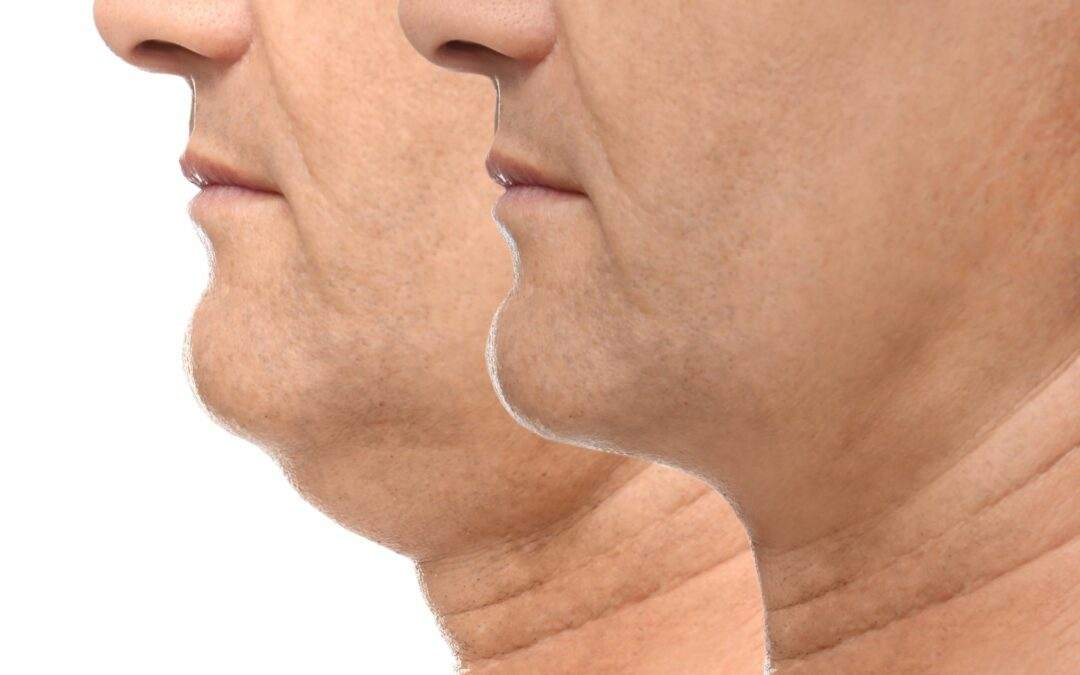 kybella