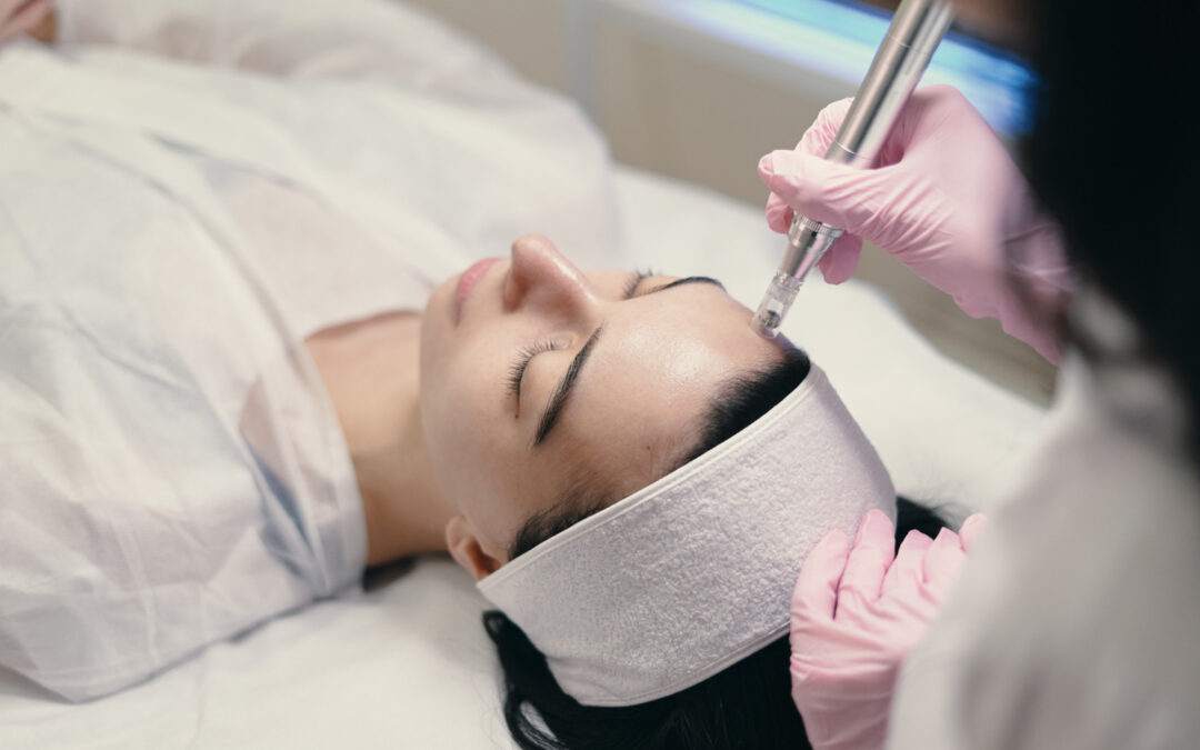 microneedling